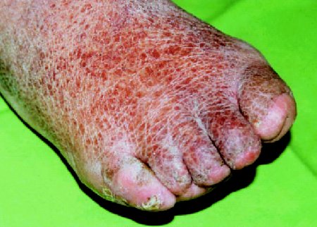 diabetes foot bőrpír kezelése