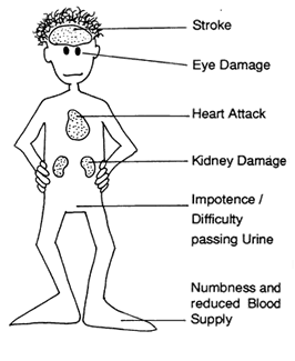 angina cukorbetegség kezelése cukor diabetes mellitus subcompensation